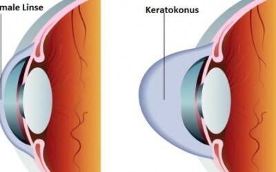 Keratokonus Symptome