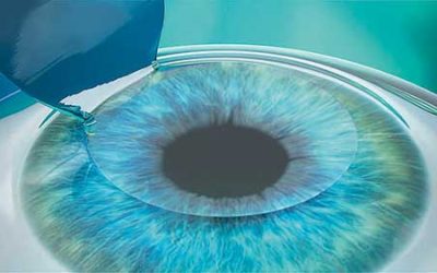Was ist Lasik?